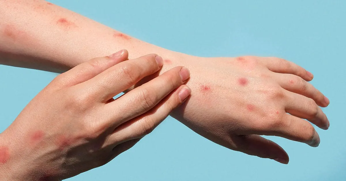 Virginia se enfrenta actualmente a un reto importante con un resurgimiento de las infecciones por Mpox en 2024.