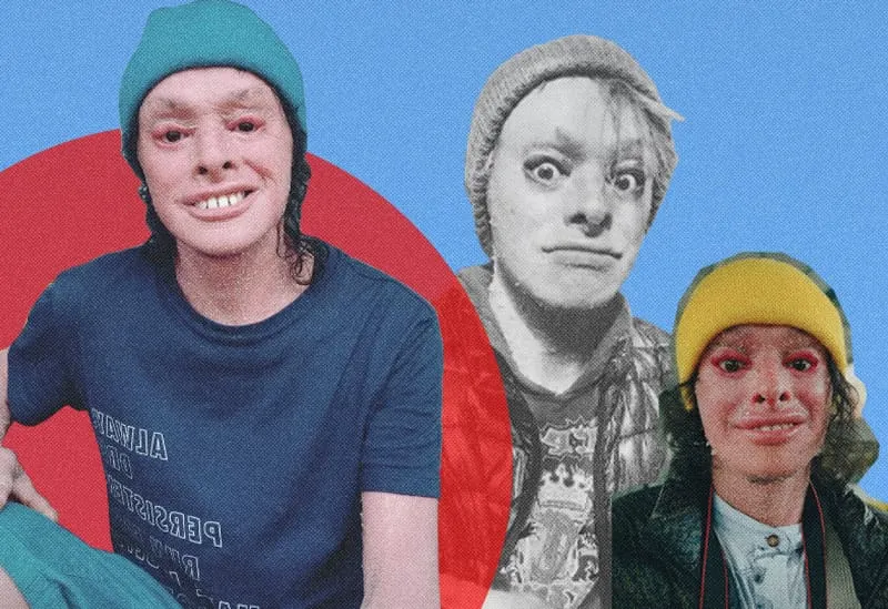 Tío Panshís ictiosis arlequín