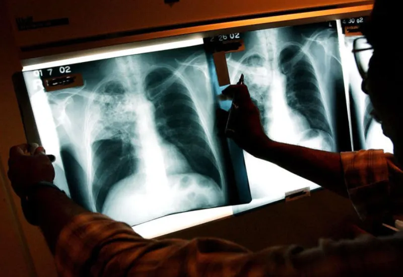 Tuberculosis California