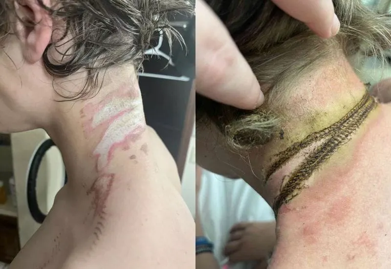 Adolescente casi muere electrocutado después de que su collar entrara en contacto con un enchufe