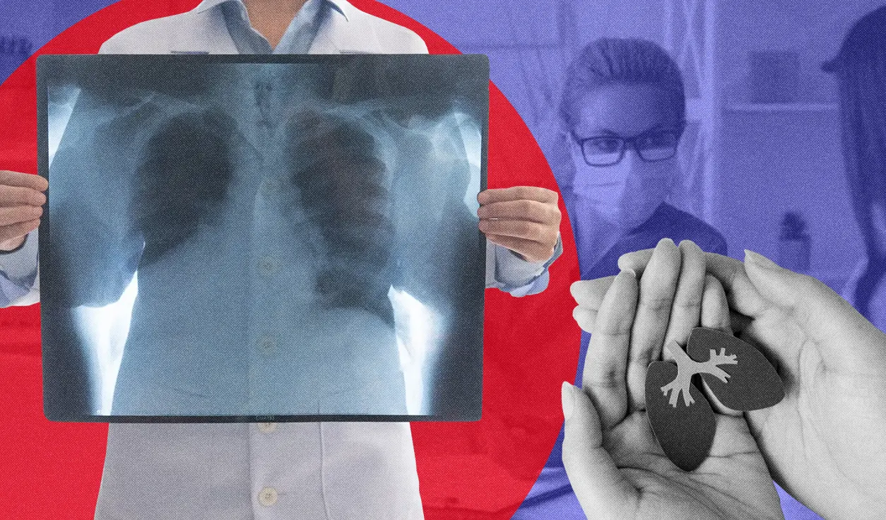 Cáncer de pulmón en latinos: un futuro esperanzador a pesar de las persistentes disparidades