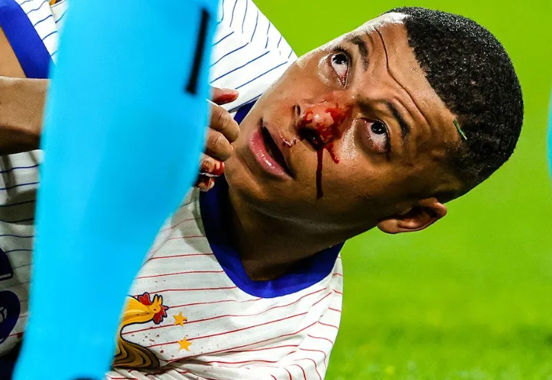 Mbappé se fractura la nariz y se pierde la fase de grupos de la Eurocopa 2024