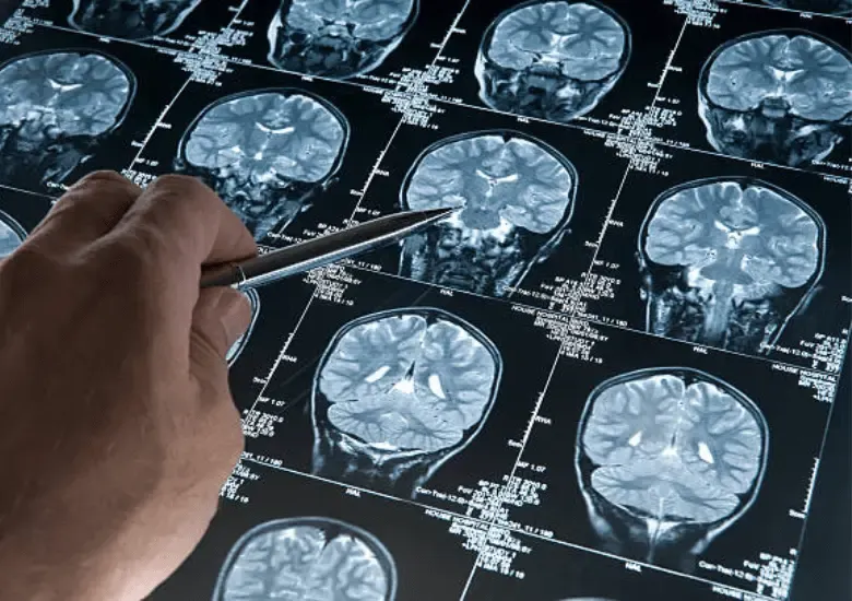 FDA aprobó Kisunla, el fármaco de Eli Lilly contra el Alzheimer