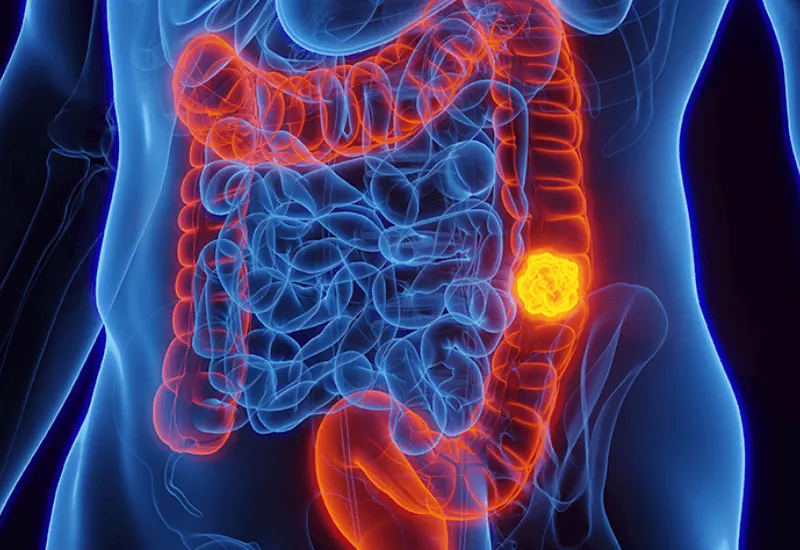 La FDA aprobó un análisis de sangre para la detección de cáncer de colon. Todo lo que debes saber