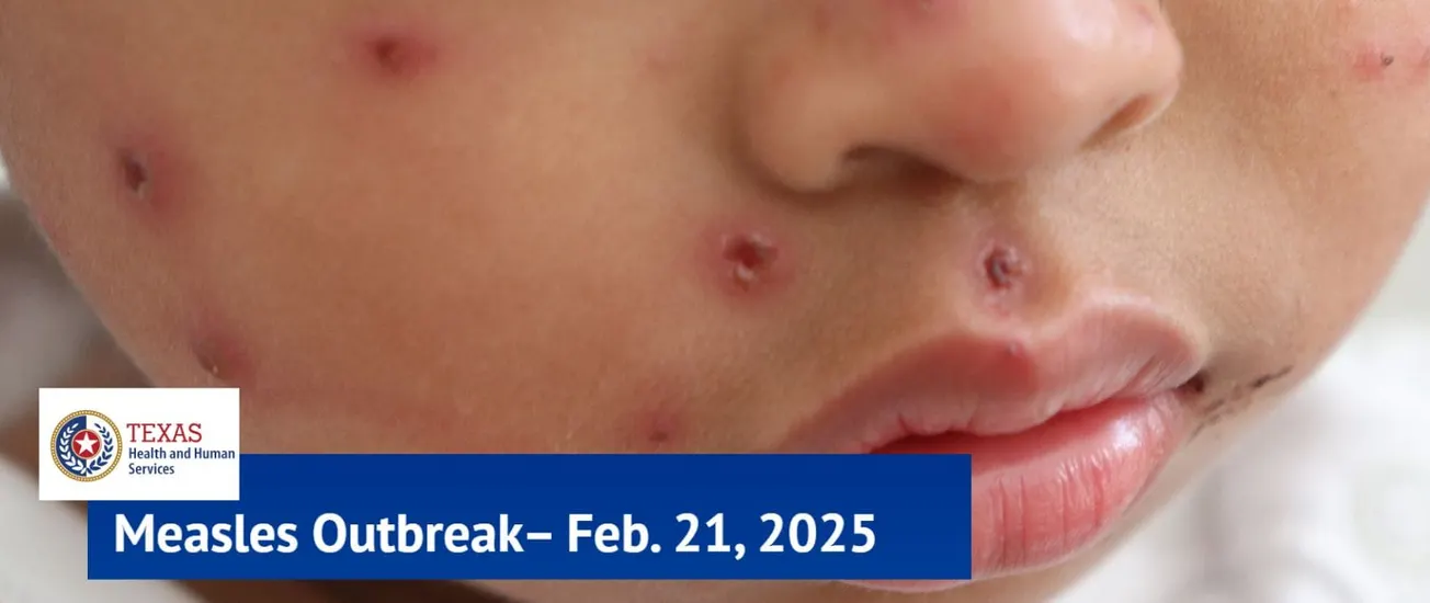 brote de sarampión en texas