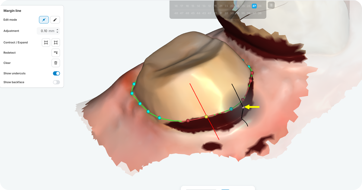 Example of AMDC AI Design showing an AI-generated dental restoration design workflow.