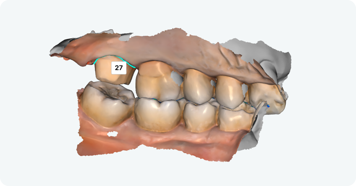 3D dental scan showing tooth number 27 selected in dental cad cam software