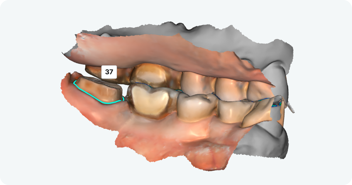 3D dental scan showing tooth number 37 selected in dental cad cam software