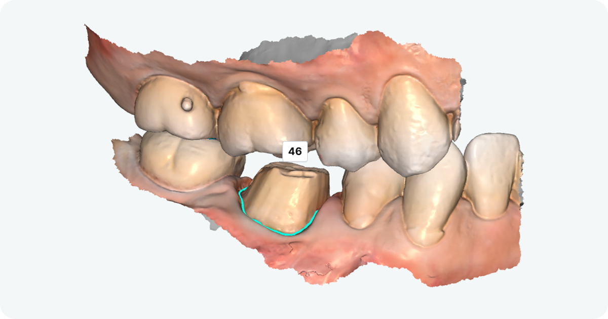 3D dental scan showing tooth number 46 selected in dental cad cam software