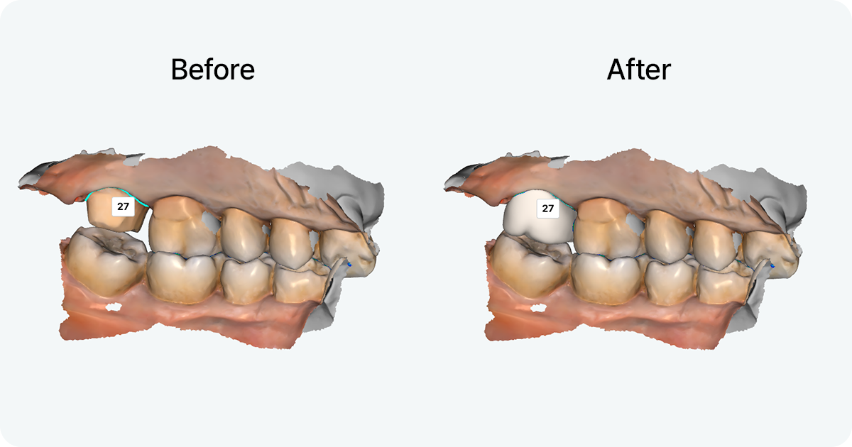 Before and after comparison of 3D crown design for tooth number 27 in dental cad cam software