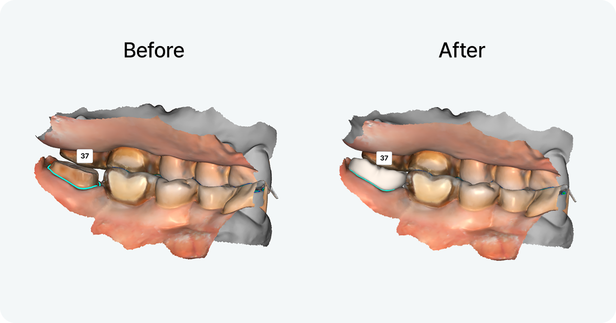 Before and after comparison of 3D crown design for tooth number 37 in dental cad cam softwar
