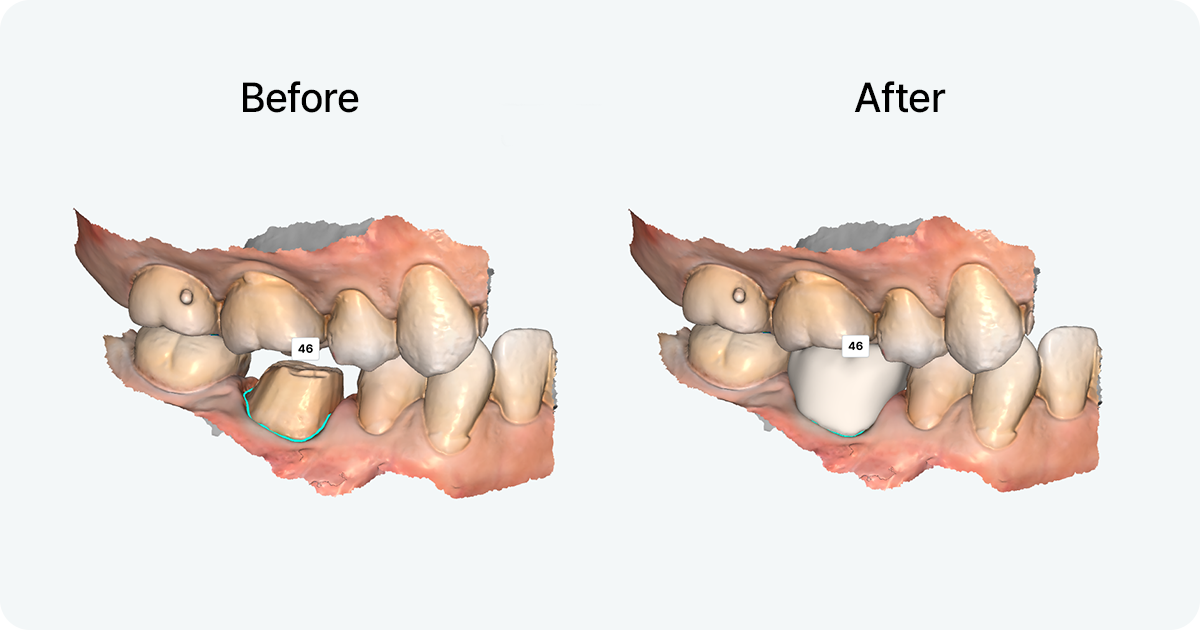 Before and after comparison of 3D crown design for tooth number 46 in dental cad cam softwar