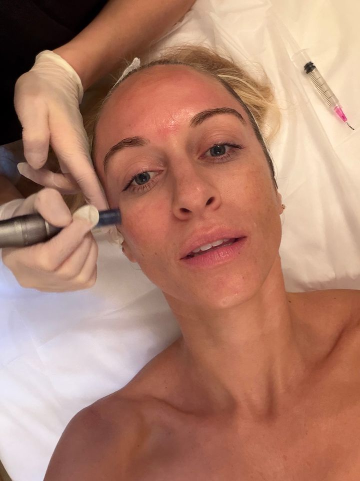 microneedling: my fall skin reset