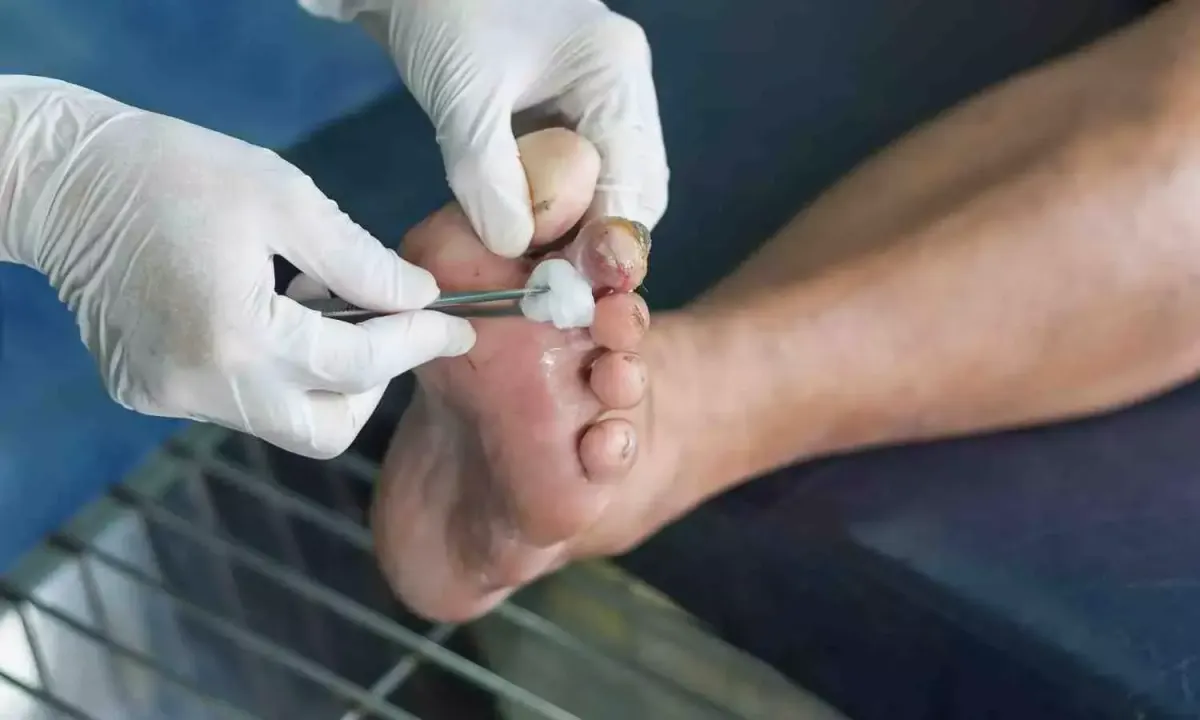 Indian Study Shows Interdisciplinary Diabetic Foot Care Can Reduce Mortality and Amputations