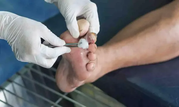 Indian Study Shows Interdisciplinary Diabetic Foot Care Can Reduce Mortality and Amputations