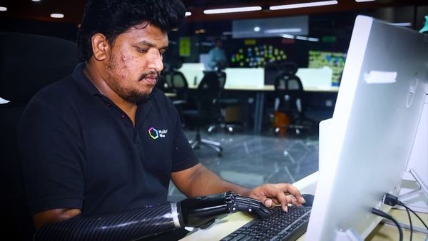 Hyderabad’s Bionic Hand Innovation Highlights India’s Growing Strength in Affordable Prosthetics