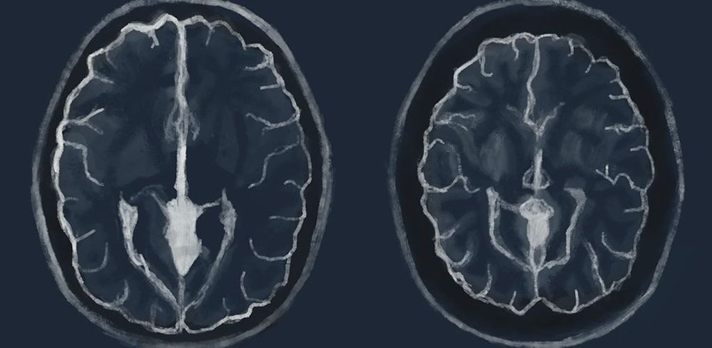 COVID-19 shrinks our brains – PM: Nothing to see here... Freedom day! post image