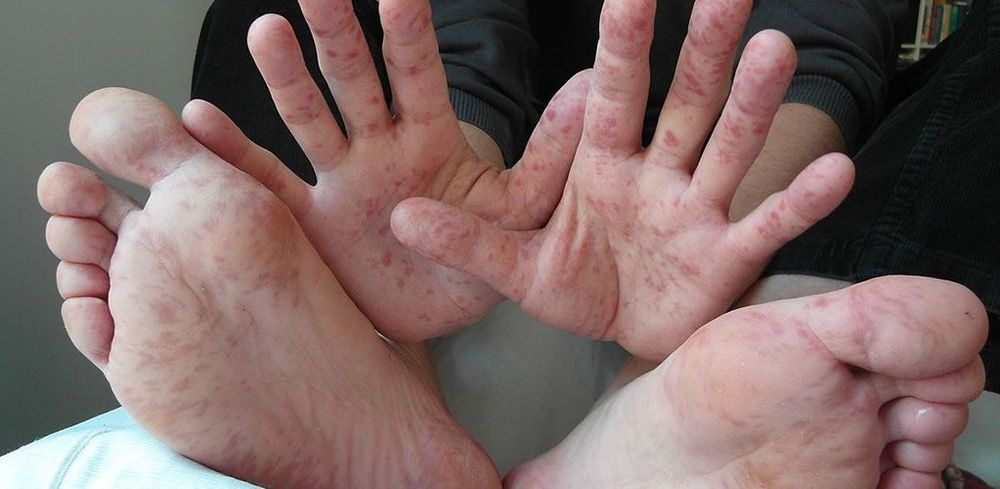 ‘Tomato flu’ outbreak in India – Here’s what it really is post image