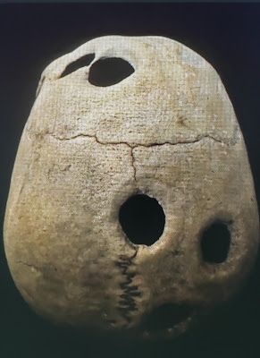 Blog No 11 Trephination: Most Ancient Operation