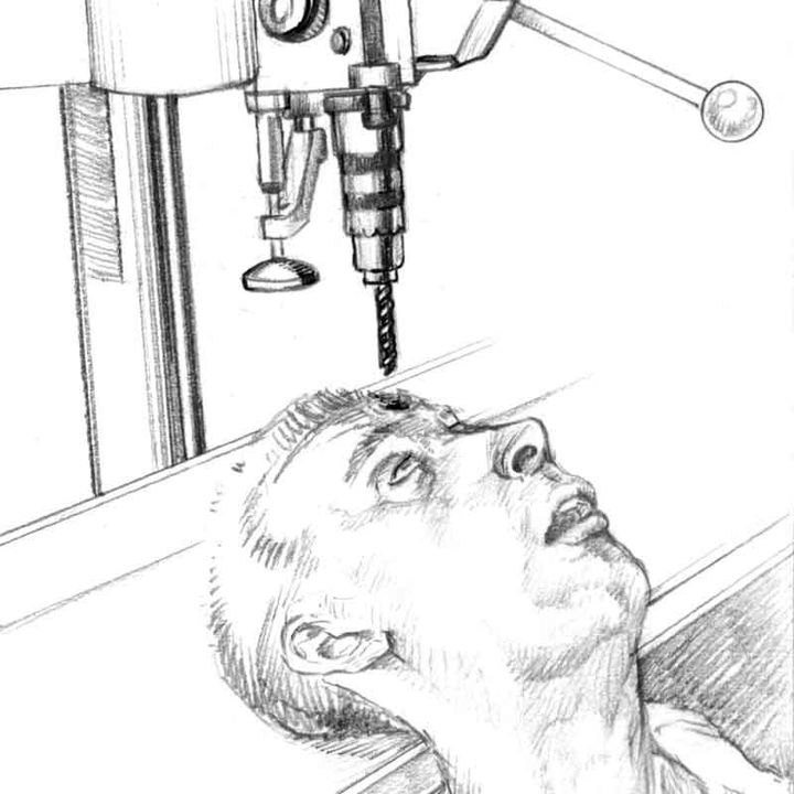 A drill press and a maimed patient, post-trepannation.