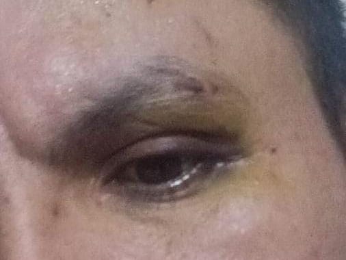 A close up of an injured eye of a man with dark hair