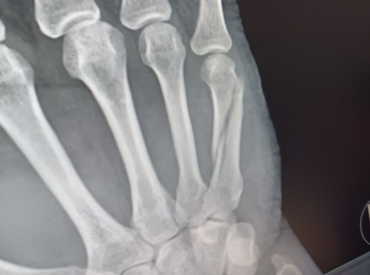 An x-ray of a hand with a fracture in the long bone beneath the pinkie finger