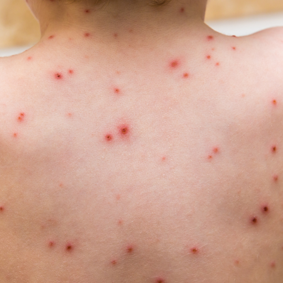 Entenda o que é a varíola dos macacos e seus sintomas