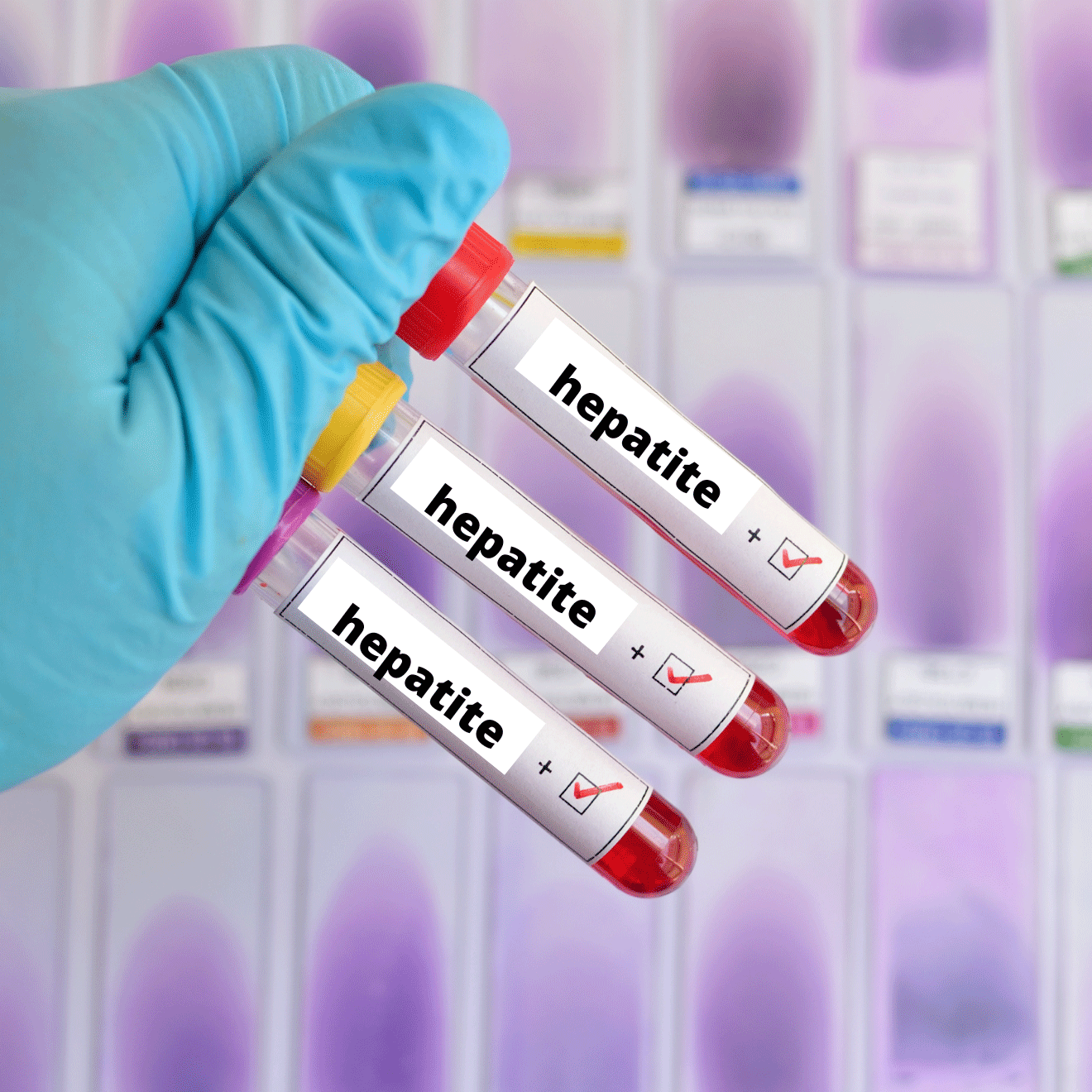 Hepatites Virais: saiba tudo sobre os Tipos, Sintomas, Tratamento e Prevenção