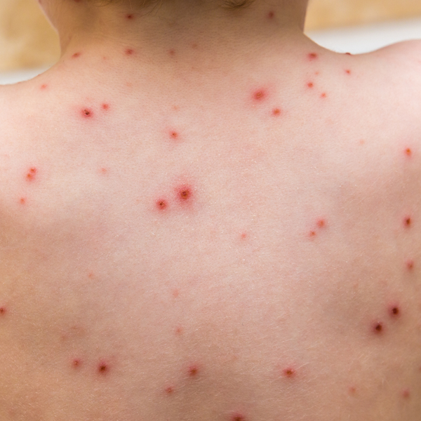 Entenda o que é a varíola dos macacos e seus sintomas