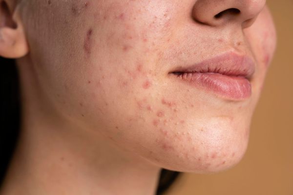 Acne adulta: causas, tratamentos e como funciona a consulta dermatologia online