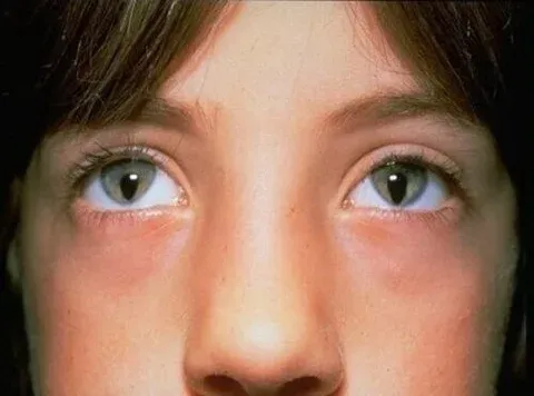 coloboma iris