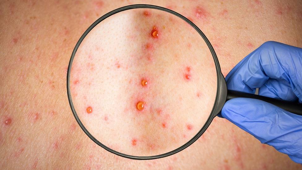 Siete casos de viruela del mono en Reino Unido: ¿cuáles son los síntomas de  esta enfermedad? - Internacional - COPE