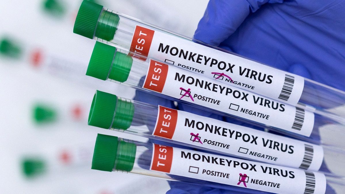 Viruela del mono: los estados con más casos
