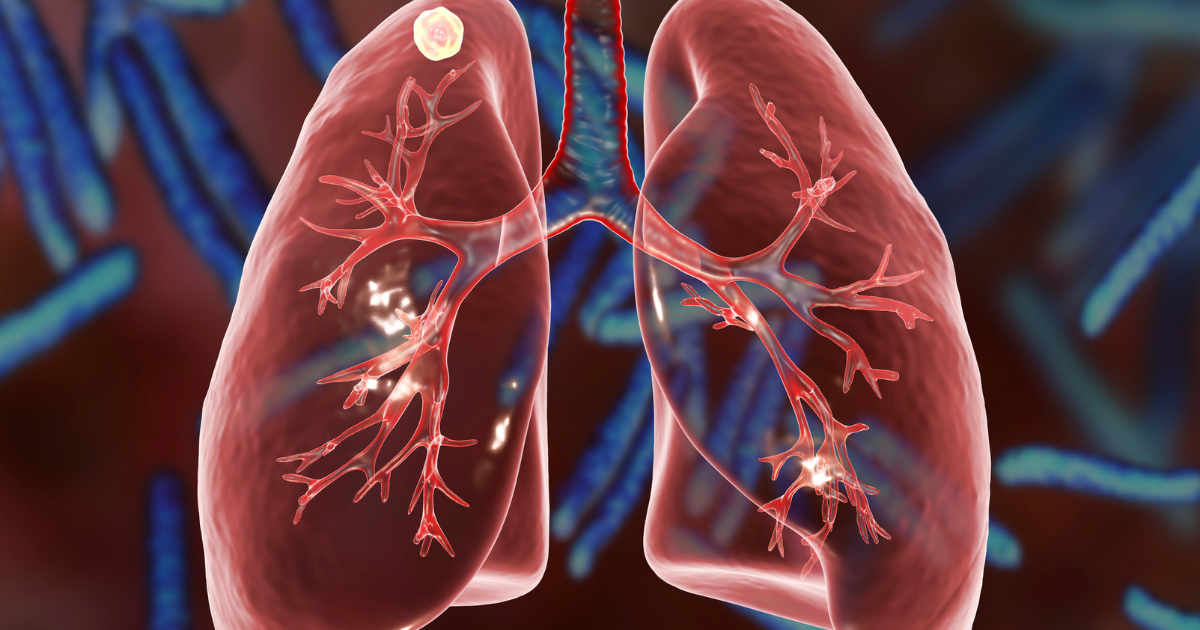 tuberculosis 