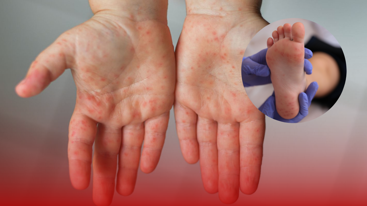 virus coxsackie medidas de prevencion