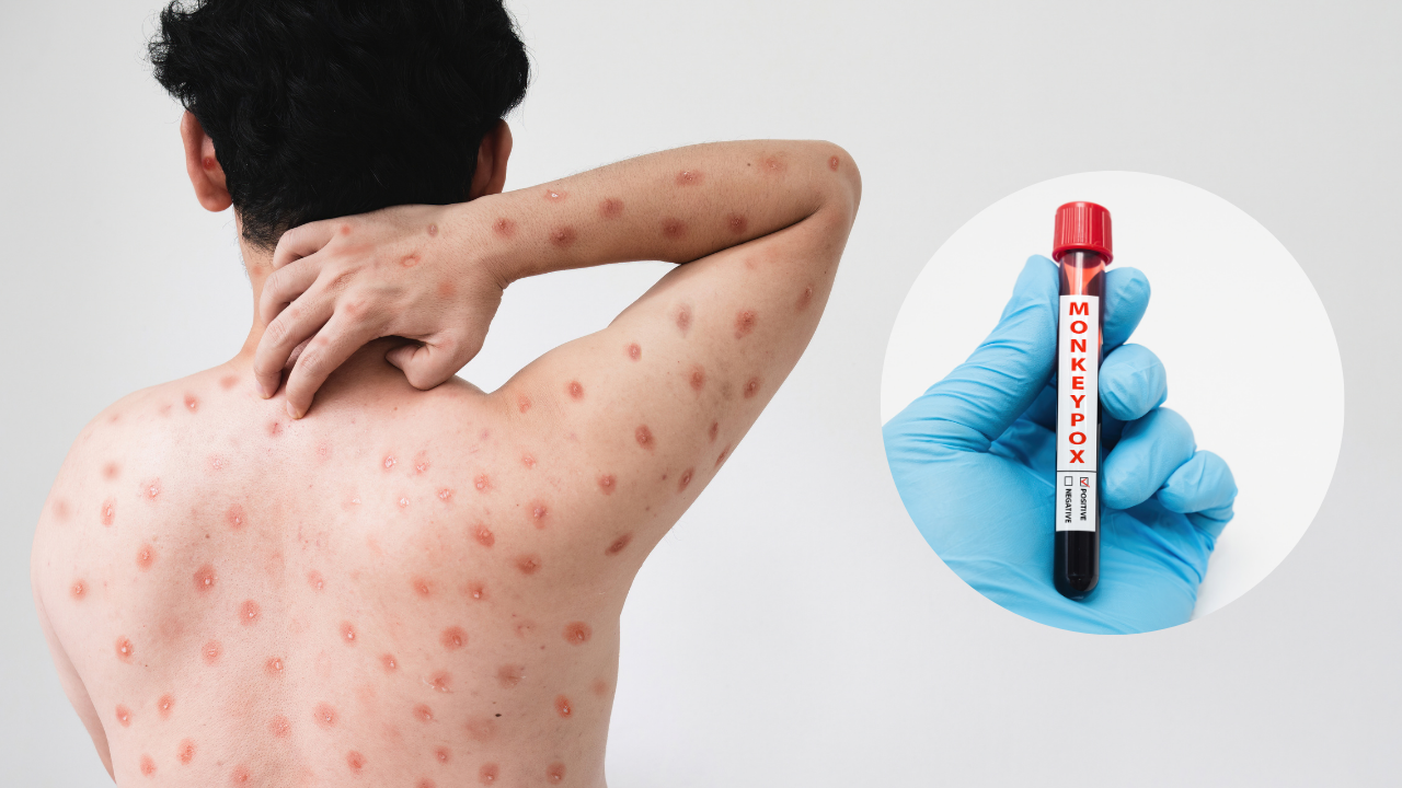 monkeypox mexico casos 