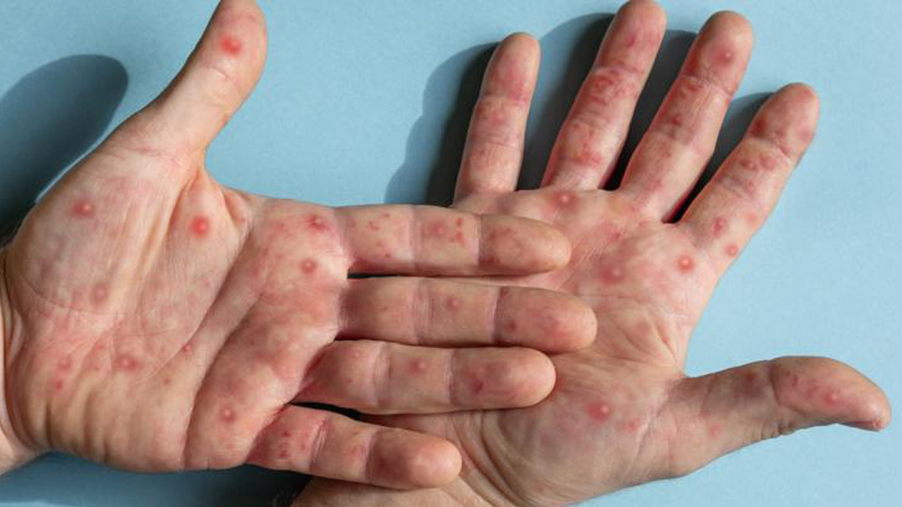 Elevan nivel de alerta para viajeros mexicanos ante mpox