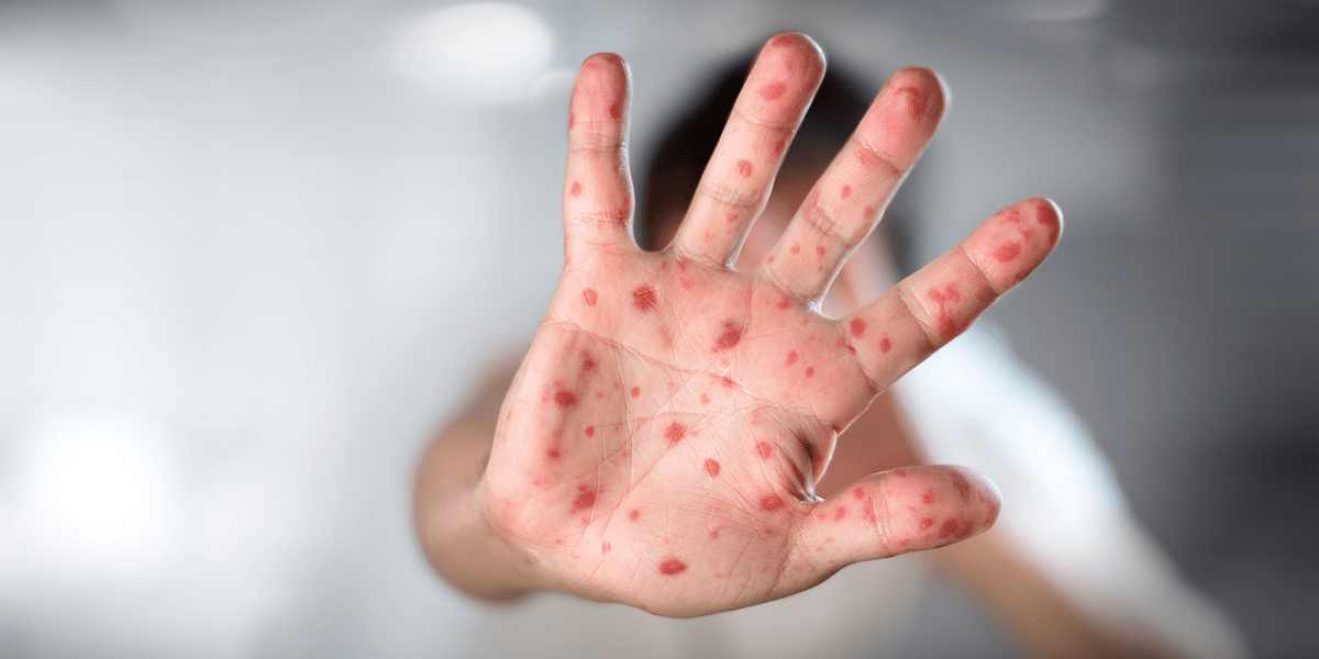El año pasado, Morelos cerró con cero casos de Mpox.