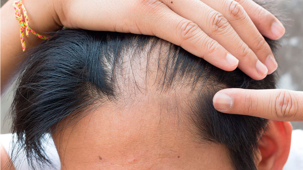 ¿Sufres de caída de cabello?