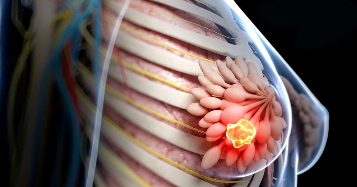 ¿Qué es el cáncer de mamá?