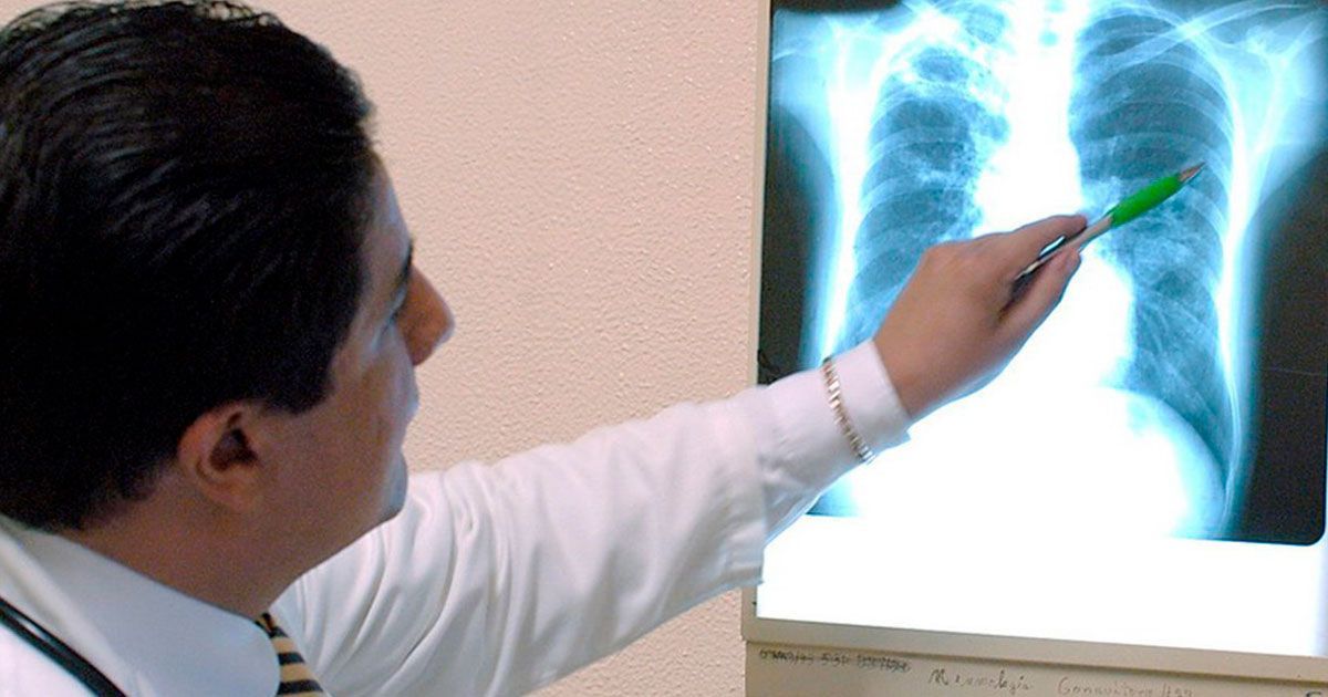 ¿Qué es la tuberculosis?