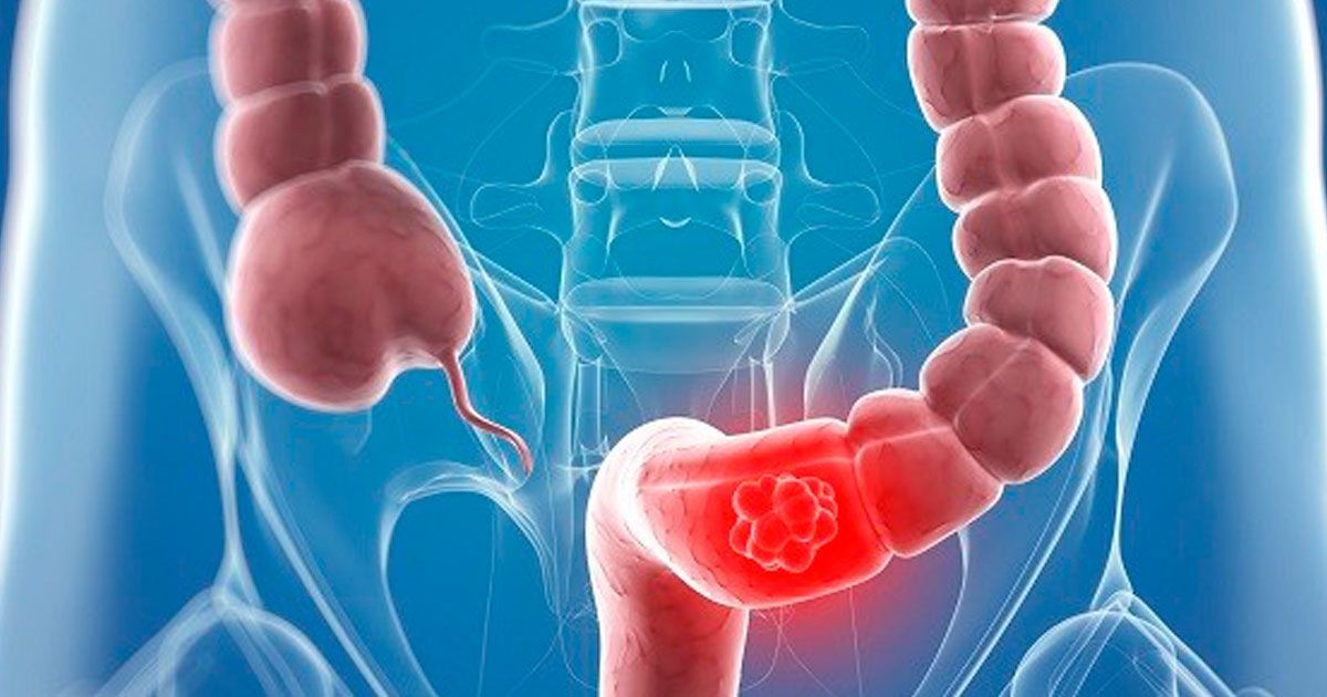 Cada año se diagnostican cerca de 15 mil nuevos casos de personas con cáncer de colon