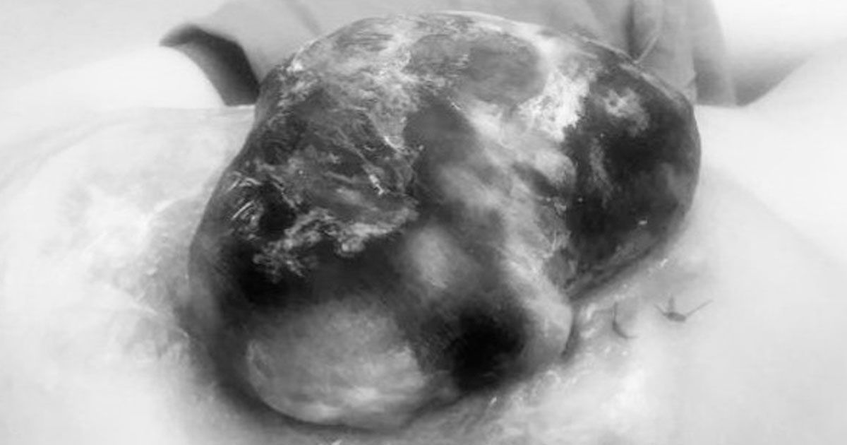 Retiran tumor de joven morelense