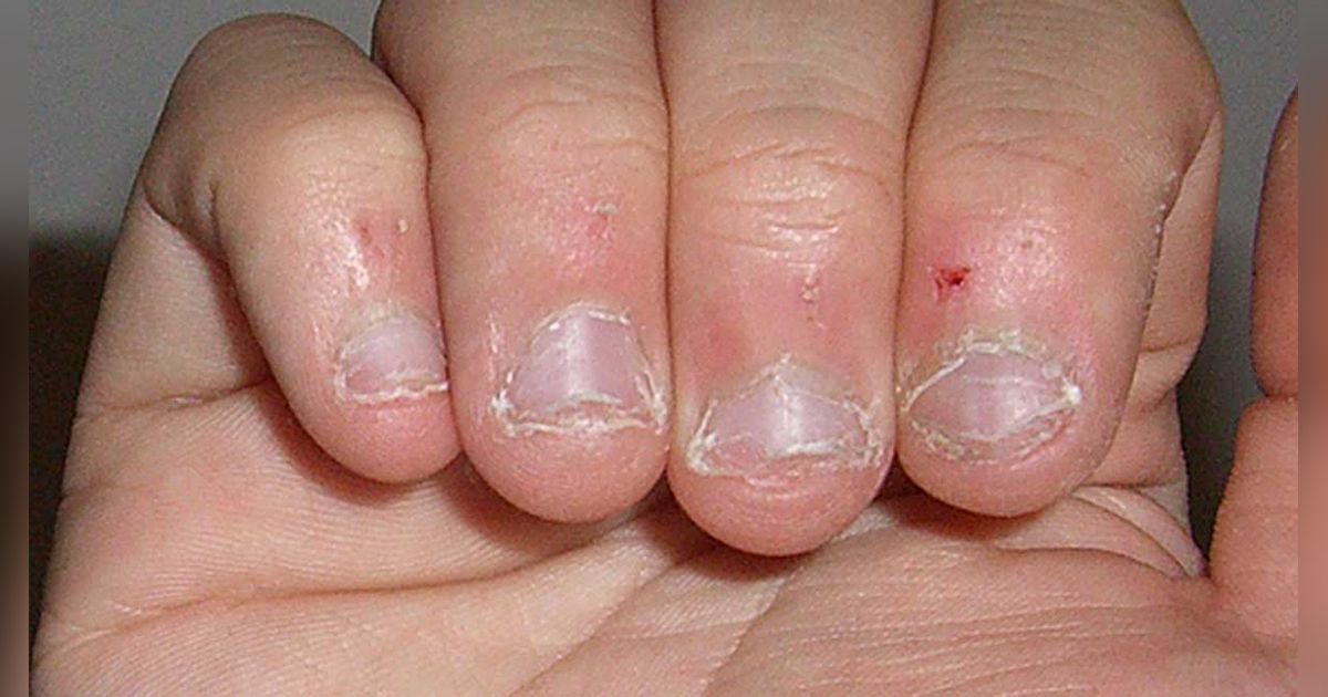 Comerte las uñas podría provocar la muerte: IMSS