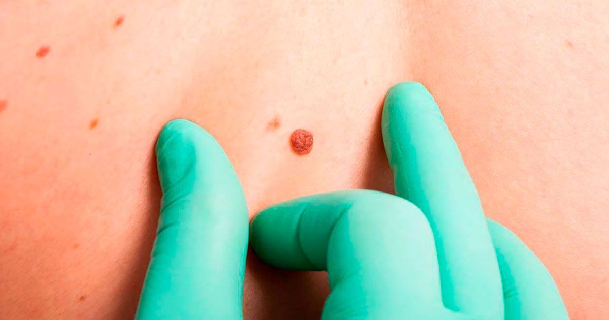 Cáncer de piel va en aumento en México