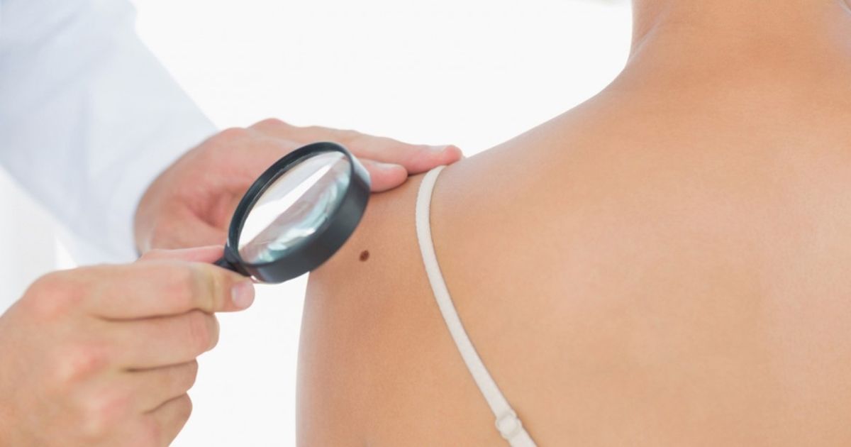 Conoce qué es el melanoma y cuáles son sus síntomas