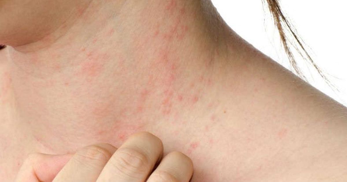 Conoce qué es la dermatitis atópica