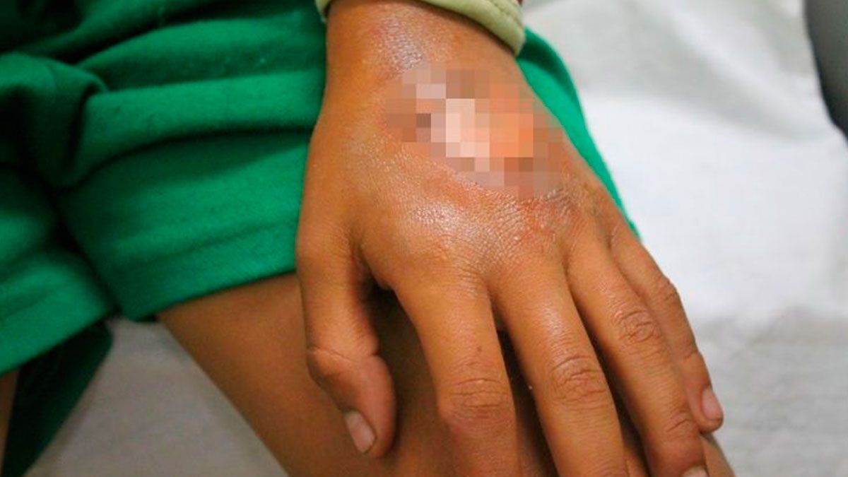 Mamá le quema las manos a su hijo por hacer berrinche