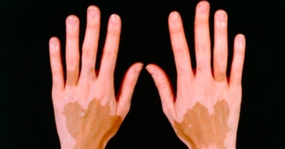 Vitíligo: enfermedad que desaparece el color de la piel