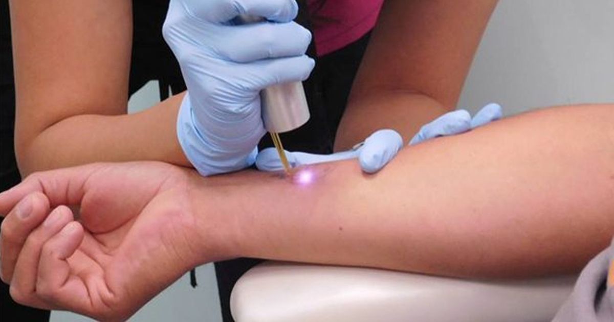 Eliminación de tatuajes, uno de los procedimientos más solicitados